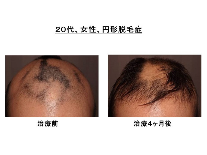 円形脱毛症　病院""